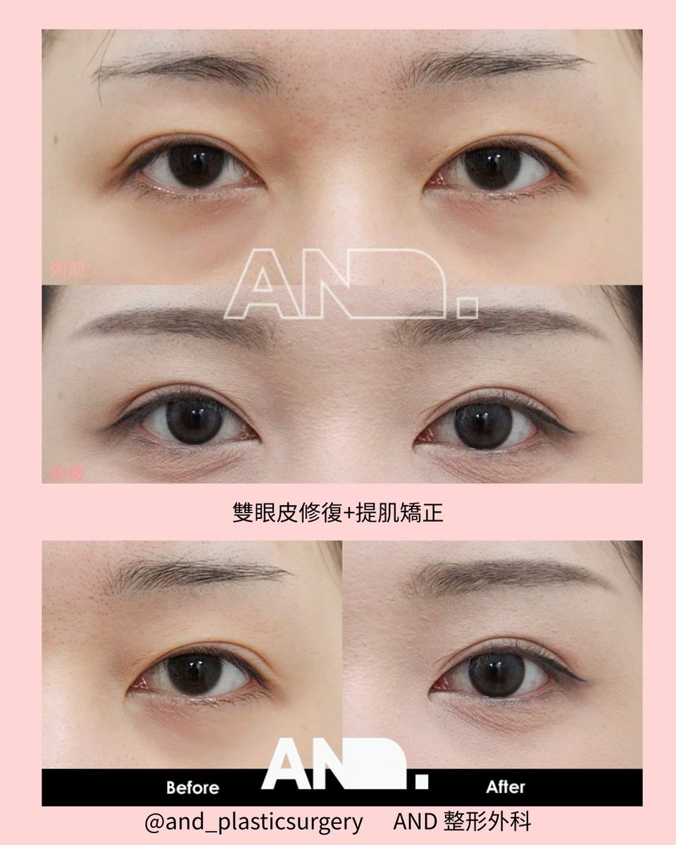 隆鼻/ 双眼皮/ 男士整形/ 抗衰/ 脂肪填充(@mightyplasticsurgery_chi) · Seoul, image size:960x1200