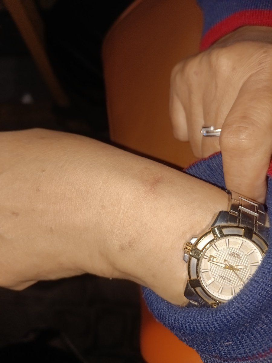 deilicated's tweet photo. tadi malam sekitar jam 20.00 WIB, mama saya kena jambret saat saya mau parkir di Kang Bubur Jl. Jolotundo Sby. pelaku sekitar 4 orang menggunakan 2 motor. gelang berhasil diambil, dan tangannya lebam karena sempat melawan. hati-hati, udah banyak kejahatan di area ini. @e100ss https://t.co/aNLH9aA8PK