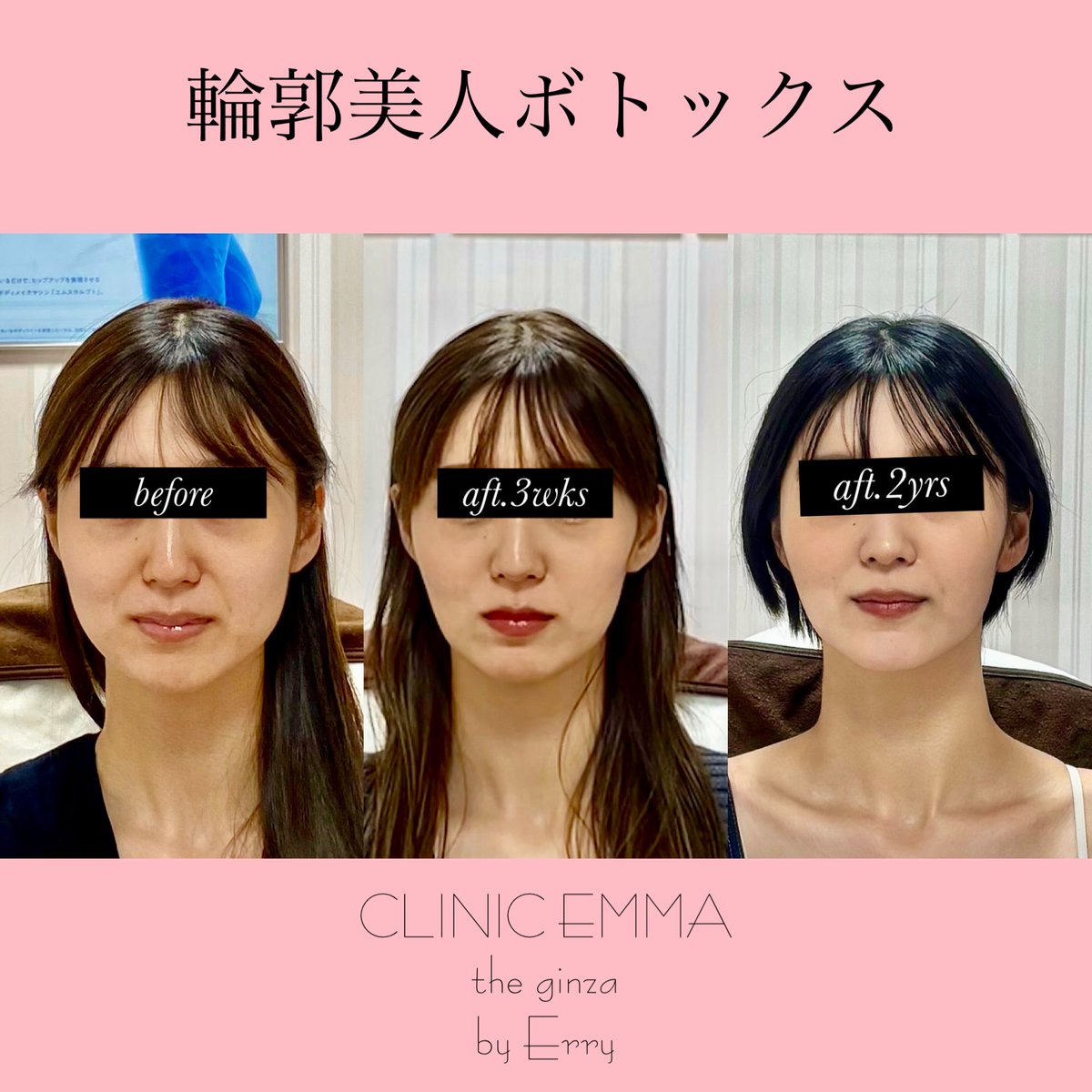 初めての施術から2年
これまで4回の治療を受けられました

笑顔はさらに可愛く😊口角下までのびていたほうれい線は消失✨ほっぺのコケはなくなり、程よいボリューム😇とにかく可愛い🩷
#表情筋デザイン #自然な美しさを引き出す #動いても綺麗な顔