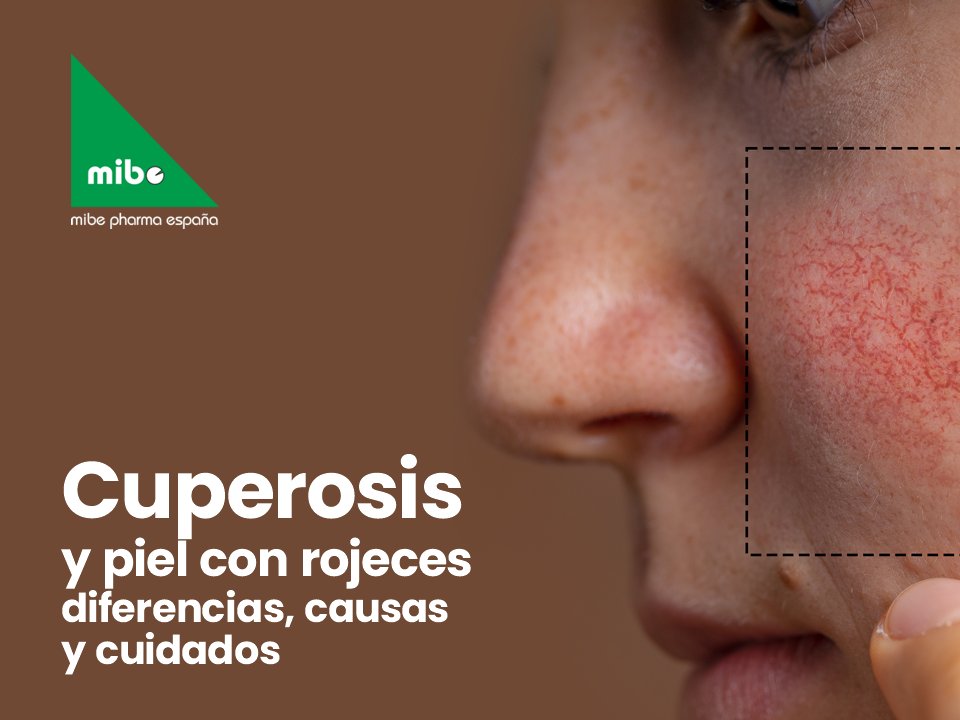 🔴 La cuperosis puede confundirse con rosácea o irritaciones pasajeras, pero requiere un enfoque específico.
 💡Identificarla a tiempo ayuda a proteger la piel y evitar que se cronifique.
 🧴Con los cuidados adecuados y apoyo dermatológico, es posible mejorar su aspecto.

 👉Lee