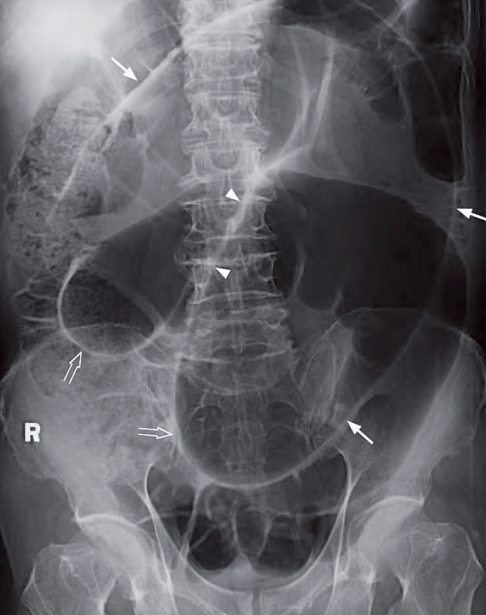 86 y/o woman with sudden severe colicky lower abdominal pain for 4 hours associated with vomiting and constipation. The abdomen was distended, with marked local tenderness and guarding.
- What’s the diagnosis and what abnormalities can you detect ?

#medtwitter #foamrad #foamed