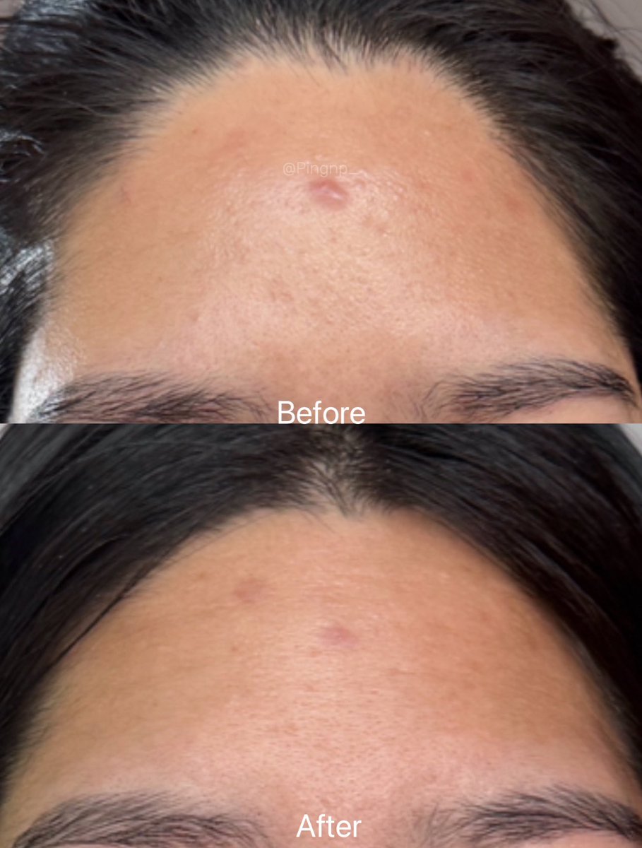 ชั้นผู้มีปัญหากับฮอร์โมนวันมามาก สิวเห่อทุกครั้งที่เป็น และนี่คือตัวช่วยลับ! Cerave ใช้ตัวนี้มาตลอดเพราะสิวหายไว ไม่ค่อยขึ้นซ้ำ ทาทั่วหน้าแทนมอยซ์ได้เลย หลังใช้ไปซักพักรอยสิวจะค่อยๆจางและผิวจะแข็งแรงขึ้นด้วย หลอดนึงคือใช้ได้นานมาก และที่สำคัญผิวแพ้ง่ายใช้ได้ เหมาะกับชาวเราสุดๆ