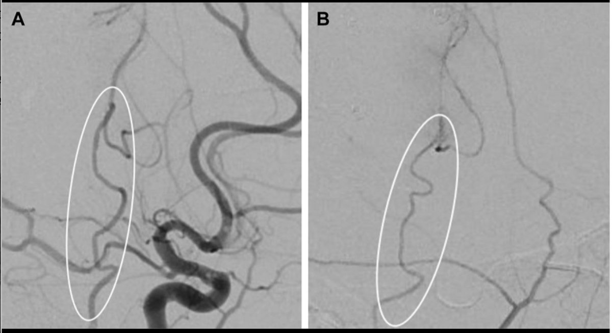 #ONSNew Interrupted Versus Running Sutures for Superficial Temporal Artery to Middle Cerebral Artery Cranial Bypass bit.ly/42021C1 by Grin et al <a href="/nyugrossman/">NYU Grossman School of Medicine</a> <a href="/CNS_Update/">CNS</a> <a href="/visishs/">Visish M. Srinivasan, MD</a> <a href="/dgolubMD/">Danielle Golub, MD, MSCI</a>