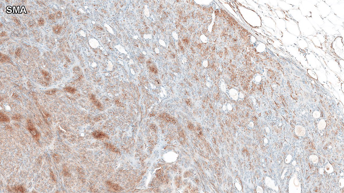 Crushed it! 🎯
The answer: adenomyoepithelioma (AME).

AME can sometimes take on a more spindled morphology, as in this case. Shown here: SMA immunohistochemistry 👇

#PathX #PathTwitter #breastpath #PathQuiz
