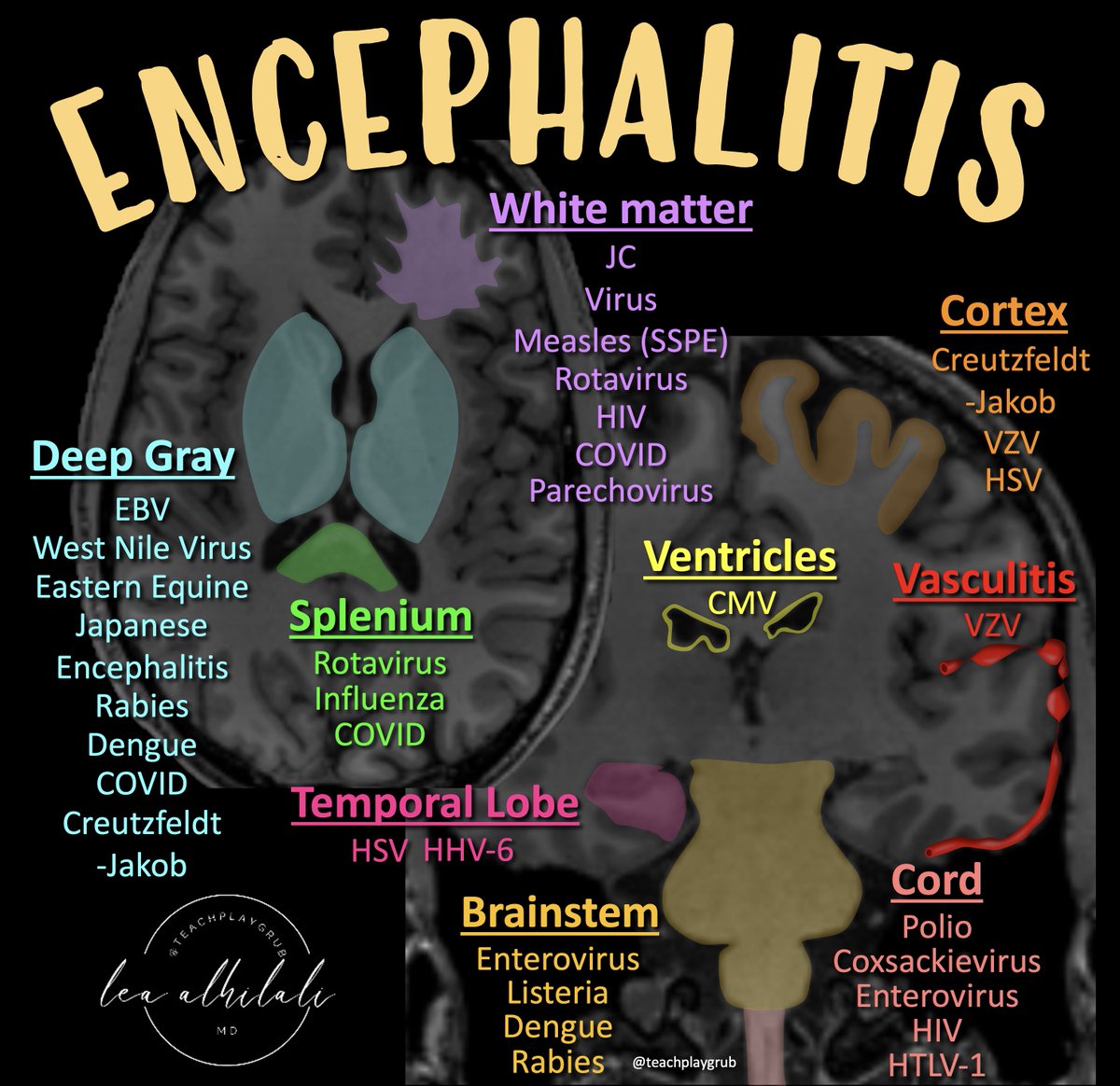 Knowledge is contagious!

Infectious encephalitis can be a difficult diagnosis, but patterns on MRI can suggest an etiology.

Most know herpes &amp; the temporal lobe

Do YOU know any more?

Here’s a figure to help you remember the most “common” encephalitis patterns for different