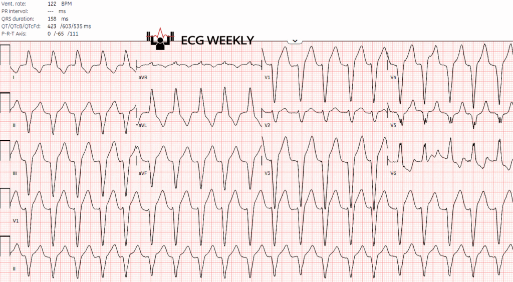 A 64-year-old man presents to the emergency department with palpitations. He was recently found to have an acute MI and is one day s/p RCA stenting. The following ECG is obtained.......ecgweekly.com/weekly-workout…