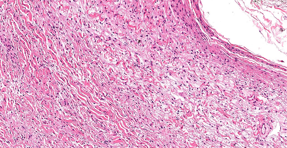Let’s continue to review low-grade spindle cell lesions of breast this week!

Case of Neurofibroma of Breast 🔬

Benign spindle cell lesion with wavy nuclei and collagen bundles—a reminder that not all breast spindle cell lesions are metaplastic.

#PathX #PathTwitter #breastpath