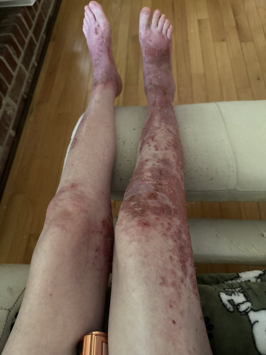 PixieStrmDesign's tweet image. Update on my atopic dermatitis!