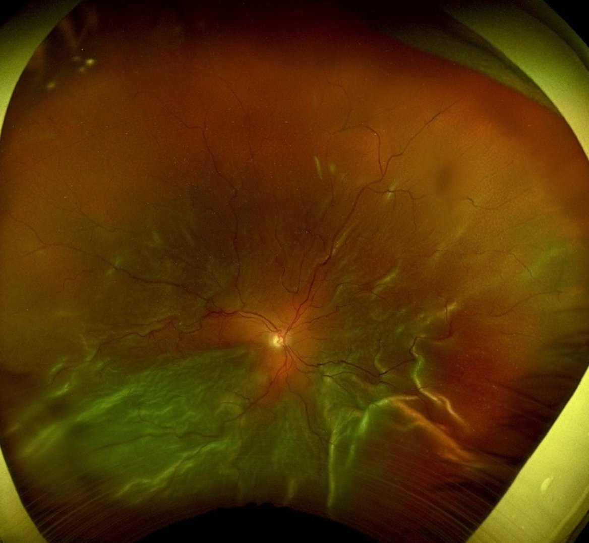 Primary macula off total rhegmatogenous retinal detachment presenting 5 weeks after symptom onset. Note hydration lines. No definite proliferative vitreoretinopathy membranes noted.