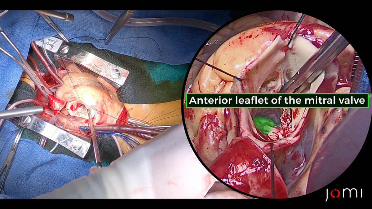 JOMIjournal's tweet photo. This case involves a 61 yr old woman with a bicuspid aortic valve-a congenital abnormality affecting ~2% of the population. Instead of the normal three leaflets, her valve has two, leading to severe calcific stenosis and an associated dilation of the ascending aorta (aortopathy) https://t.co/ZjImU3hgRx