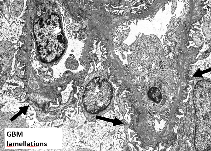 grace_choung's tweet photo. Diffuse mesangial sclerosis (DMS)
🔹Nephrotic syndrome in early life 
🔹Sporadic &amp;🧬(e.g., WT1)
🔹Mesangial expansion⬆️with⬆️dz stage
🔹⏲️➡️Shrunken glomeruli &amp; corona of hypertrophied podocytes
🔹⏲️➡️FSGS &amp; IFTA
🔹EM: lamellated GBMs &amp; diffuse🦶process effacement
#renalpath https://t.co/HVpkMegZqD