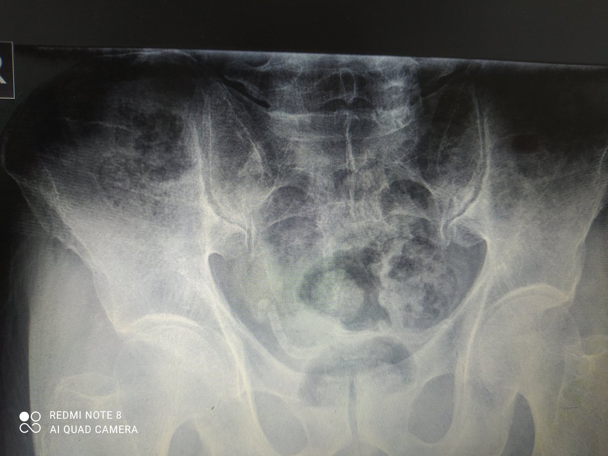 💔 My Father Is Dying in Pain and Can’t Sleep 💔

An accident tore his pelvic ligaments. He struggles to move and the pain is unbearable.

I am helpless, and he urgently needs treatment to save his life.

🙏 Every donation is a lifeline of hope and relief.
chuffed.org/project/131168…