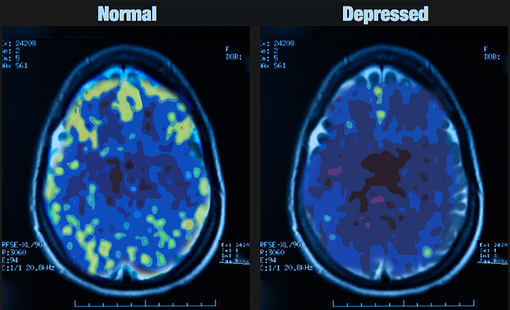 Te han mentido.

La depresión no es una enfermedad mental que se cura únicamente con pastillas.

Tu cuerpo tiene mecanismos naturales de curación. Al activarlos, puedes recuperarte de forma natural.

Esto es lo que puedes hacer para curarte de la depresión (sin tomar pastillas)