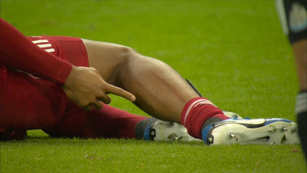 The mark on Virgil van Dijk's leg after that challenge from Anthony Gordon...
