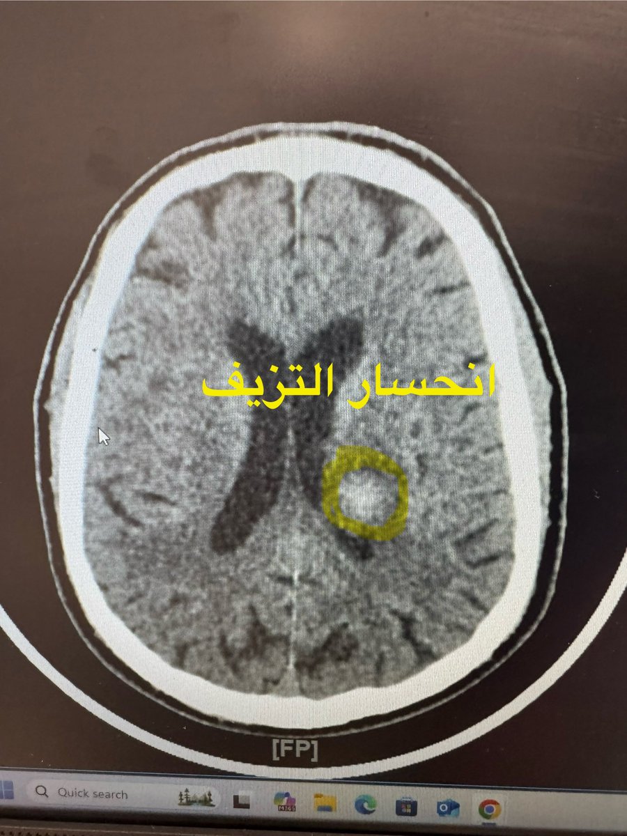 EyadFaizo's tweet photo. علاج نزيف دماغي فقط بالسيطرة و ضبط ضغط الدم و ادوية و محاليل دون جراحة لذلك لا تستهين بمتابعة الضغط بشكل دائم خاصه لأبائنا و امهاتنا 
في الاشعات الفرق بين نزيف و بعد السيطره عليه بعشره ايام. https://t.co/pxJDyIqHhW
