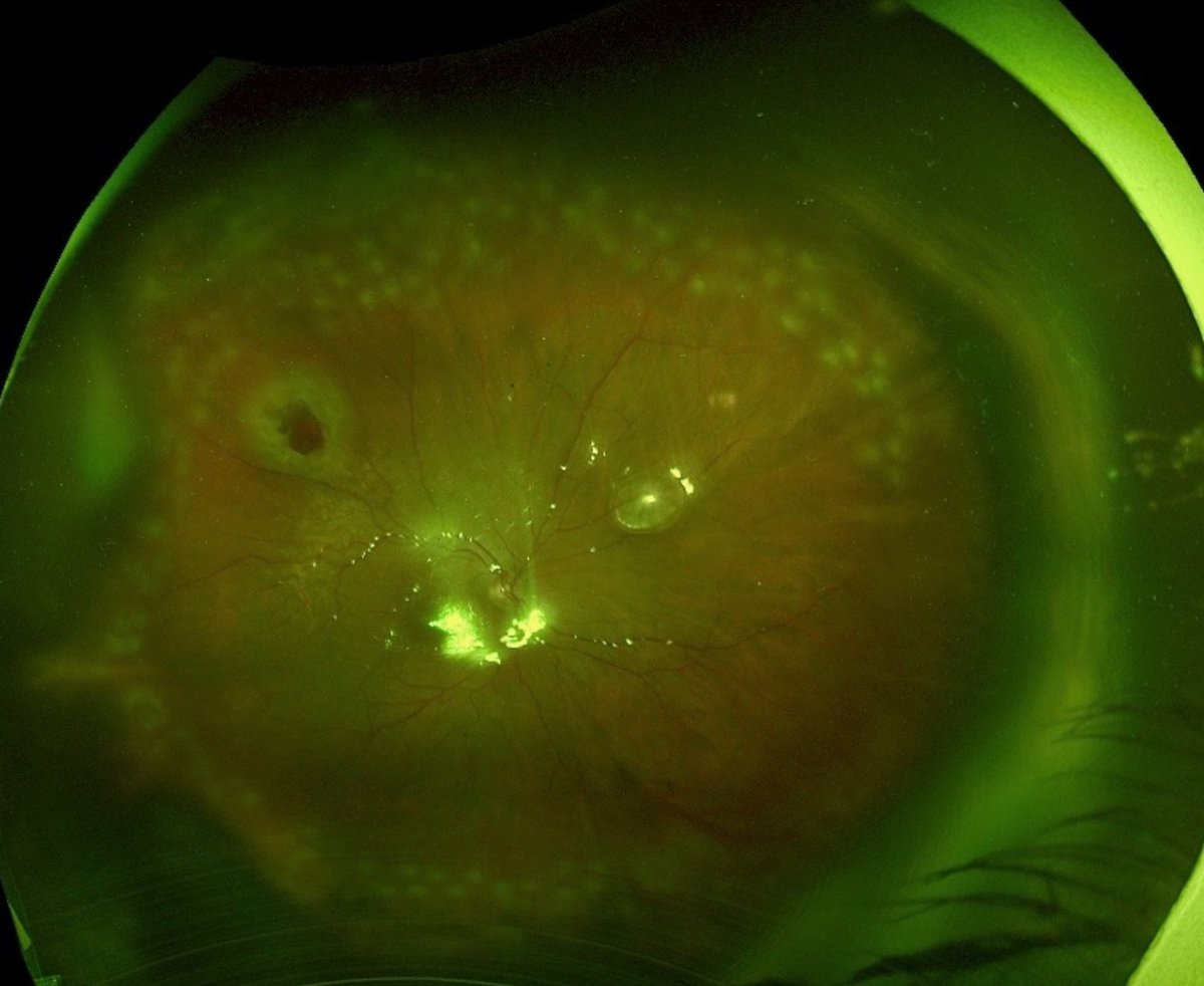 Retinal reattachment in silicone oil filled eye. Note laser around superotemporal drainage retinotomy and some peripheral scatter laser. Also not superonasal subretinal gas.