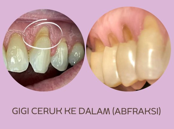koas gigi jakpus 🦷🚀 tweet media