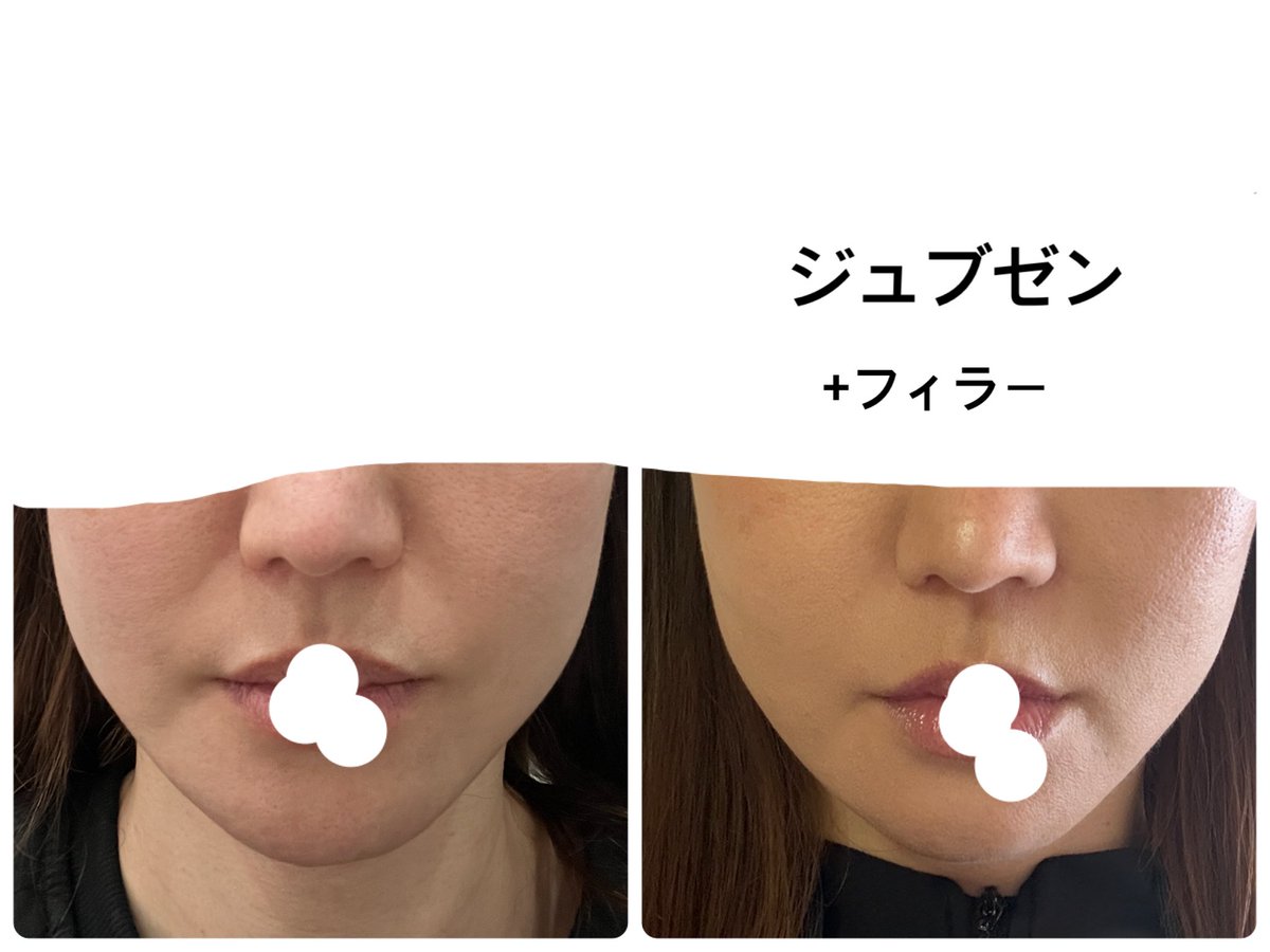 ジュブゼンのおかげで左のほうれい線が本当に「消失」と言っていいレベルで改善した。私は完全にやってよかった。内出血全くなし。針跡程度。ダウンタイムというものがほぼなくこの効果を得られたの本当に嬉しい😭DM何件かいただいていましたが、私はルミで受けました。（PR案件とかではありません）