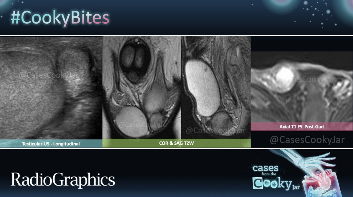 Cases From the Cooky Jar (@casescookyjar) on Twitter photo 29 M with a painless palpable hemiscrotal mass.
What is the diagnosis?
We’ll post the answer in 24h. Share companion cases with us using #CookyBites #228. We will RT the best cases!
#RGphx <a href="/cookyscan1/">Cooky Menias</a> <a href="/RadioGraphics/">RadioGraphics</a> 29 M with a painless palpable hemiscrotal mass.
What is the diagnosis?
We’ll post the answer in 24h. Share companion cases with us using #CookyBites #228. We will RT the best cases!
#RGphx <a href="/cookyscan1/">Cooky Menias</a> <a href="/RadioGraphics/">RadioGraphics</a>
