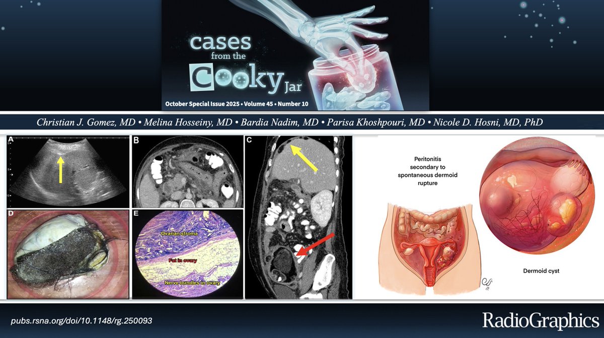 33 F presents with sudden severe lower abdominal pain and pelvic tenderness 😣😖
Diagnosis ⁉️🤔🩺💭

Answer: 🔗 pubs.rsna.org/doi/10.1148/rg…
Have a companion case? Share using #CookyBites #231. We will RT the best cases!

#RGphx <a href="/cookyscan1/">Cooky Menias</a> <a href="/RadioGraphics/">RadioGraphics</a>