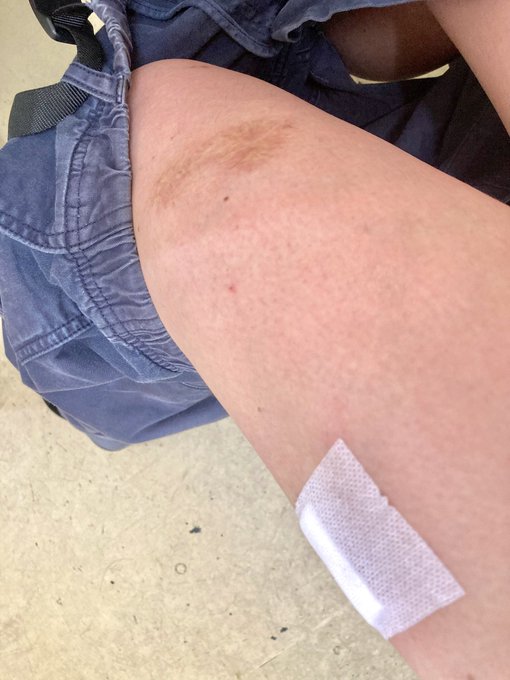 あいたたた…
また傷が増えちゃった🩸
#閲覧注意 