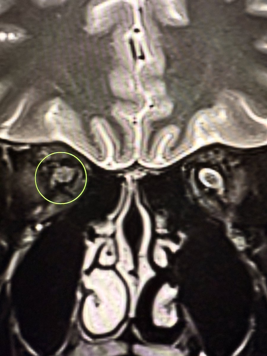 Optic nerves on  T2 fat-sat coronal:

Normal side → crisp bright CSF rim around the optic nerve. 

Optic neuritis side → swollen nerve, CSF cuff lost, rim disappears.

A simple way to remember: when the halo vanishes, think neuritis. 

I call this the “Halo-loss sign” of optic