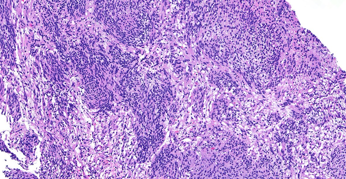 Case of Schwannoma of Breast 🔬

A little Antoni A, a little Antoni B, and some Verocay bodies—a textbook nerve sheath tumor in an uncommon site.

#PathX #PathTwitter #breastpath