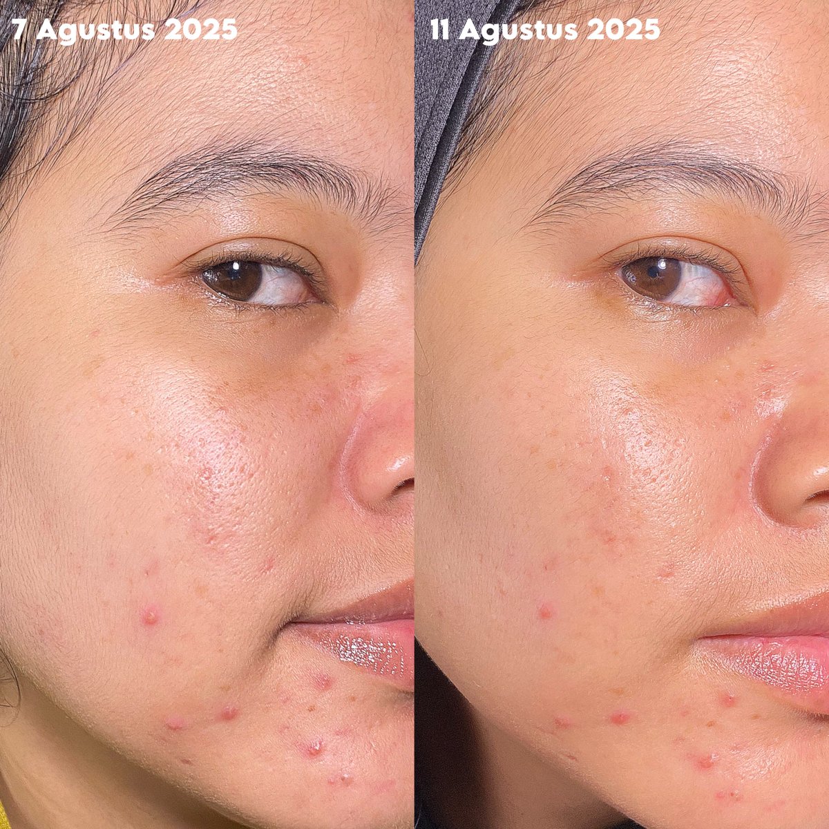 MEMANG CUMA SERUM INI JAGONYA! 😱
baru 3 harian udah kelihatan efek cerahnya 😏✨