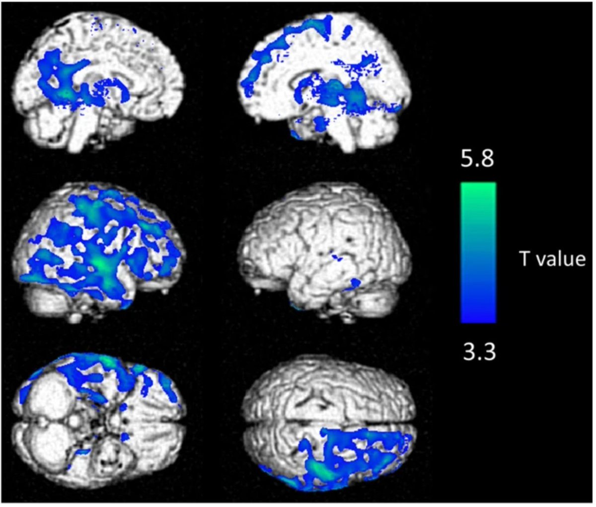 Long COVID patients have reduced metabolism in the right frontal and temporal lobes of the brain. Is this brain fog being visualized?

\ The Discovery:
Researchers from the Department of Nuclear Medicine at Université de Lorraine, in Nancy, France, intravenously injected a