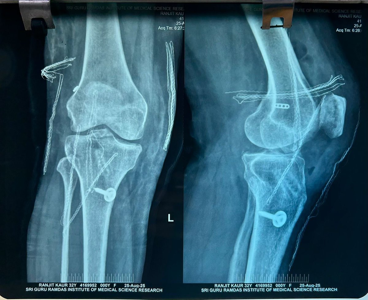 DrDardi's tweet photo. Arthroscopic repair ACL https://t.co/pzUD3xiByI
