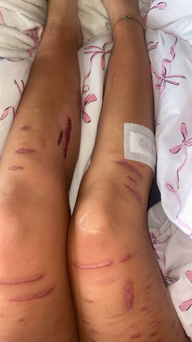 CeriganG's tweet photo. My college told me I can’t wear shorts like wtf I can change my legs and I always cover my fresh/healing ones so I don’t get the problem 
(Shtwt beanstwt scarstwt 988twt) https://t.co/YfPtALuGeI