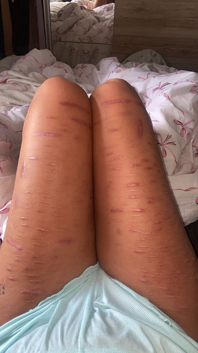 CeriganG's tweet photo. My college told me I can’t wear shorts like wtf I can change my legs and I always cover my fresh/healing ones so I don’t get the problem 
(Shtwt beanstwt scarstwt 988twt) https://t.co/YfPtALuGeI