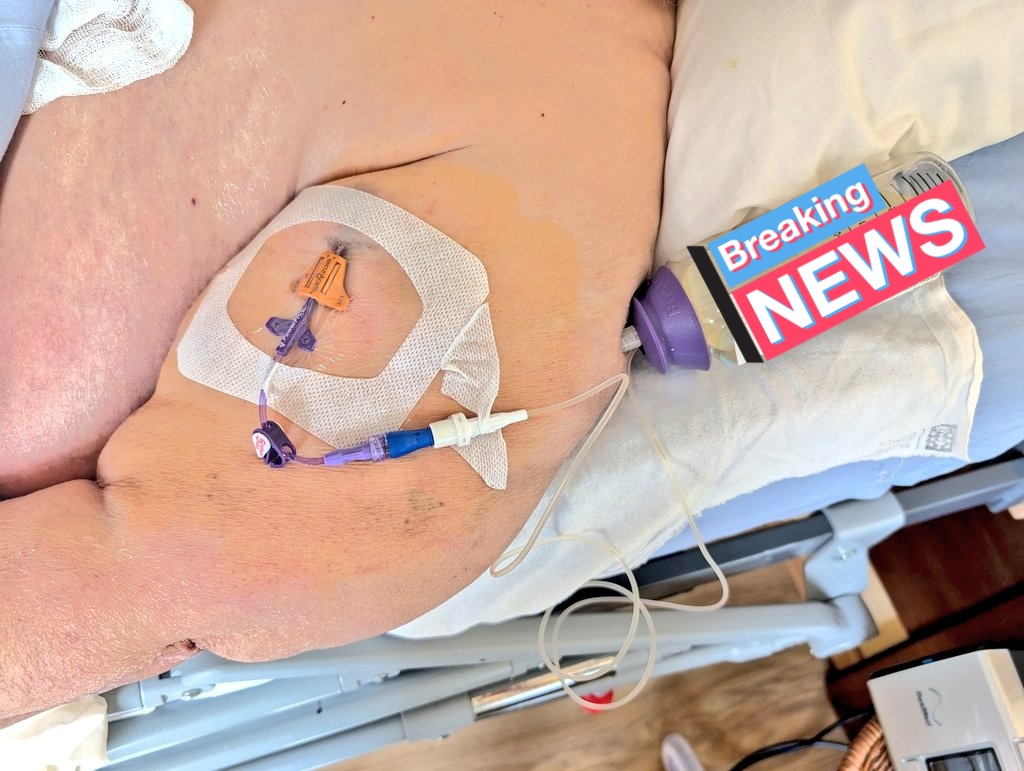 PICC vía cefálica en paciente domiciliaria con obesidad Mórbida.
Está zona de inserción facilita el mantenimiento VS cara int, y evita complicaciones mecánicas por acodamiento/torsión en  tunelizaciones extensas a través  zonas de tejido adiposo abundante y sin adecuado soporte.