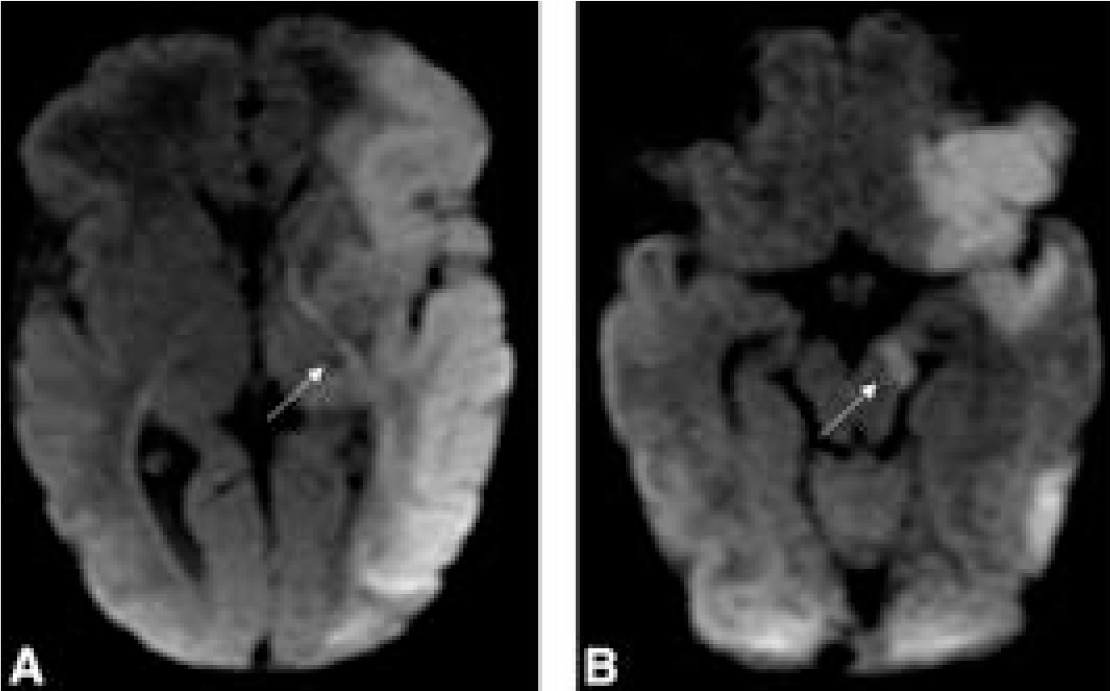 Neurographics (@asnrographics) on Twitter photo From the April-June 2025 Issue of #Neurographics: Imaging of Cerebral Palsy: A Primer for the Radiologist ow.ly/niW350WISwB From the April-June 2025 Issue of #Neurographics: Imaging of Cerebral Palsy: A Primer for the Radiologist ow.ly/niW350WISwB