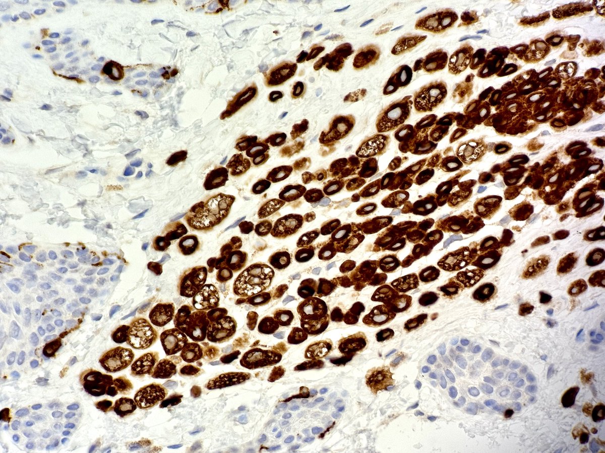 A beautiful example shared with me by a good colleague of mine, Hutan.
#BalloonCell / Sebocyte-like degenerative changes in an intradermal #nevus 
#pathology
#dermatology
📸 2 S100
📸 3 Melan A
🤓
