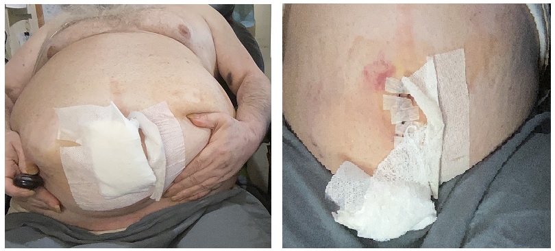 Grandpa Karr had his 11th surgery a week ago this last Sunday, my bowels got stuck in my hernia (5th hernia surgery) and so far this is the only pictures I have. My tummy is going to be messed up for awhile with another scar. Would be nice if I had someone to be Live-In care. https://t.co/sVXNROrxhq