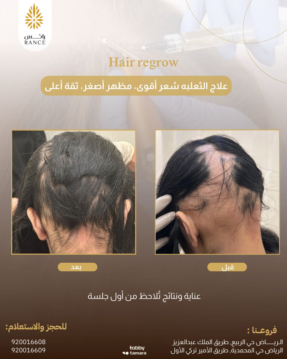 RanceClinic's tweet photo. ✨ تقنية Hair Regrow ✨
وداعًا للصلع الوراثي وتساقط الشعر 👋
حل حديث وفعّال بديل لزراعة الشعر، متوفر حصريًا في عيادات رانس.
استرجع ثقتك وابدأ رحلتك نحو شعر صحي وكثي�� 💇‍♂️
📍 الرياض
#HairRegrow #زراعة_الشعر #علاج_الصلع #تساقط_الشعر #الرياض #عيادات_رانس #شعر_كثيف #عناية_بالشعر https://t.co/VFQuMebCIC