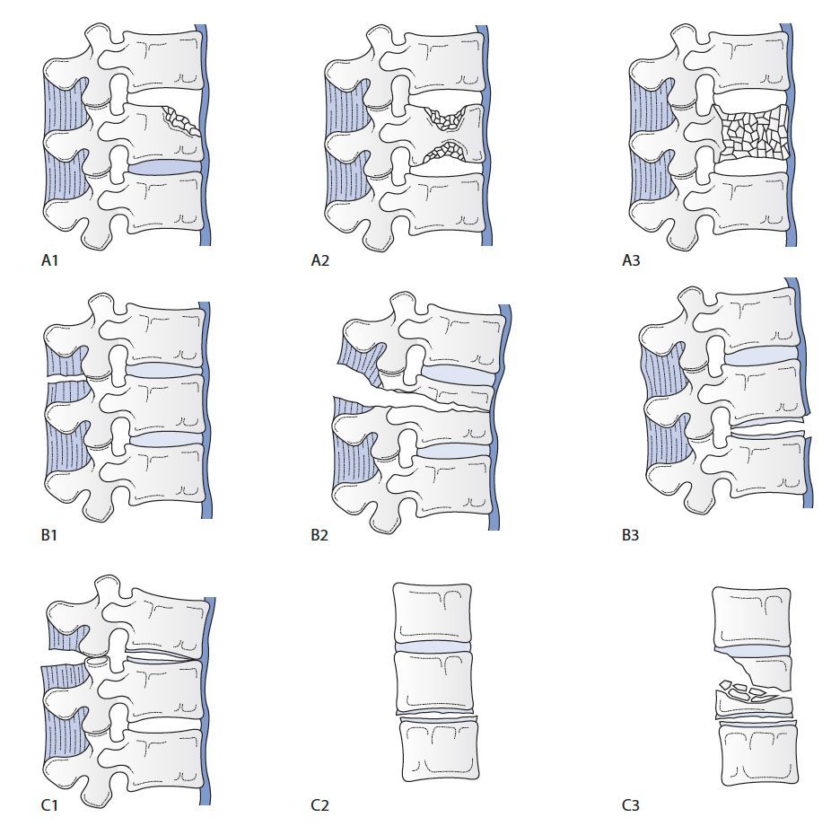 AO classification of vertebral injuries. (Data from Magerl F, Aebi M, Gertzbein SD, et al. A comprehensive classification of thoracic and lumbar injuries. Eur Spine J 1994;3:184–201.)