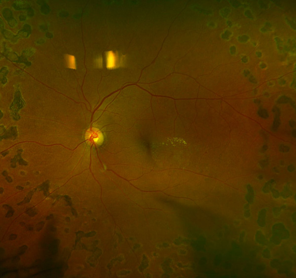 Diabetic macular edema with lipid exudate. Just sparing foveal center.