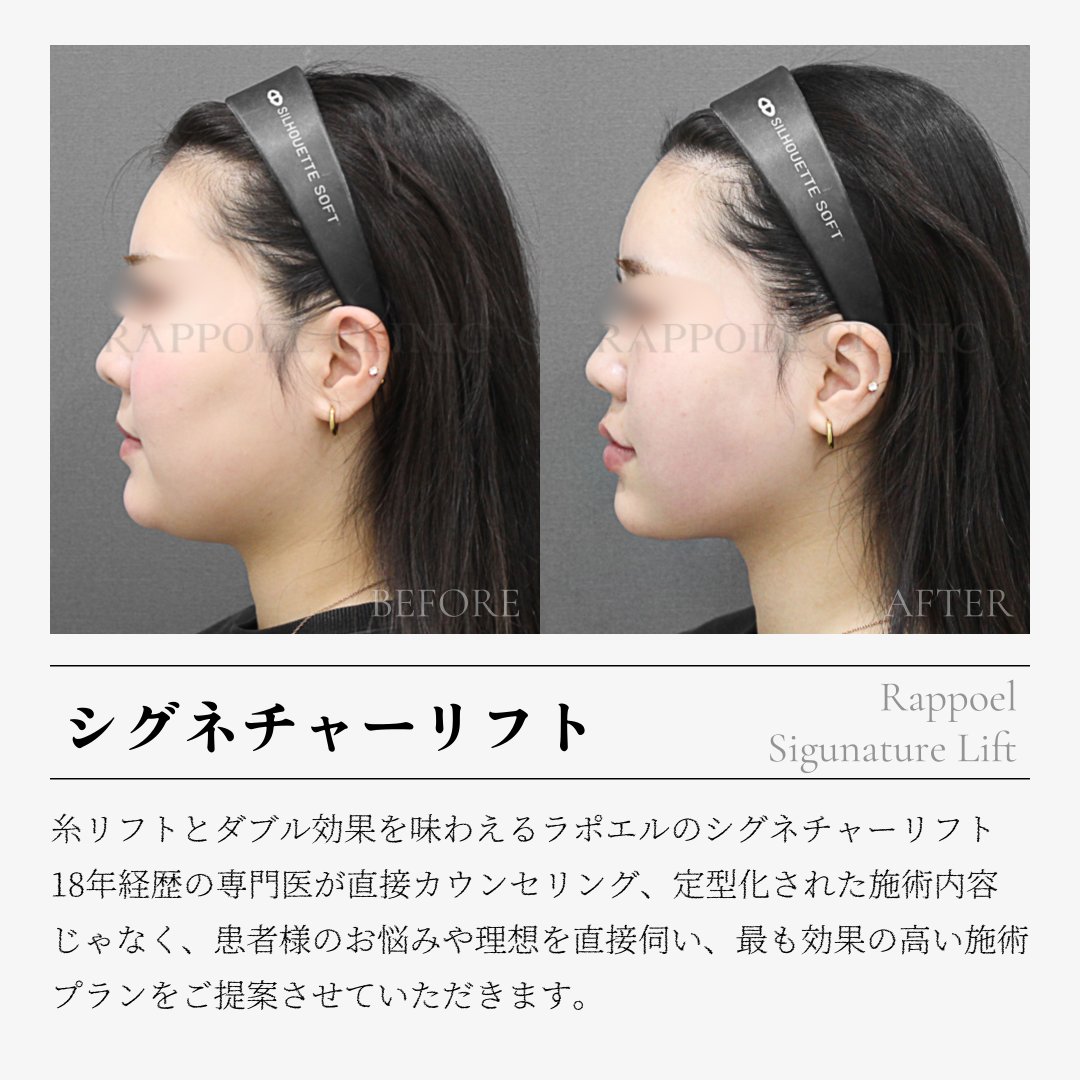 rappoelclinic's tweet photo. 4世代極超音波レーザー💫
オンダリフト✨

ラポエルでは
糸リフトとの最強組み合わせ
シグネチャーリフト🪡

ハリとリフトアップまで
小顔パッケージ🔥
で施術しております✨

単体施術ももちろんできます！

💚お問い合わせ：https://t.co/JEA7coIAgg

⏰ 診療時間：
平日 10:30~20:00／土曜 10:30~17:00（休憩 13:00~14:00）

#ラポエル #ラポエルクリニック #糸の神 #オンダリフト #糸リフト #韓国美容 #韓国整形
