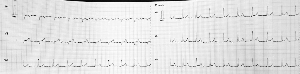 OnlyEcg1's tweet photo. Lewis Lead. Rhythm?

#Cardiovascular #MedTwitter #EKG #EPeeps_bot #Epeeps #ECG #CardioEd #Cardiologist #Paramedics #medicalstudent #MedicalEducation #Cardiology #CardioTwitter #MedicalEmergency https://t.co/X9JyouTBkM