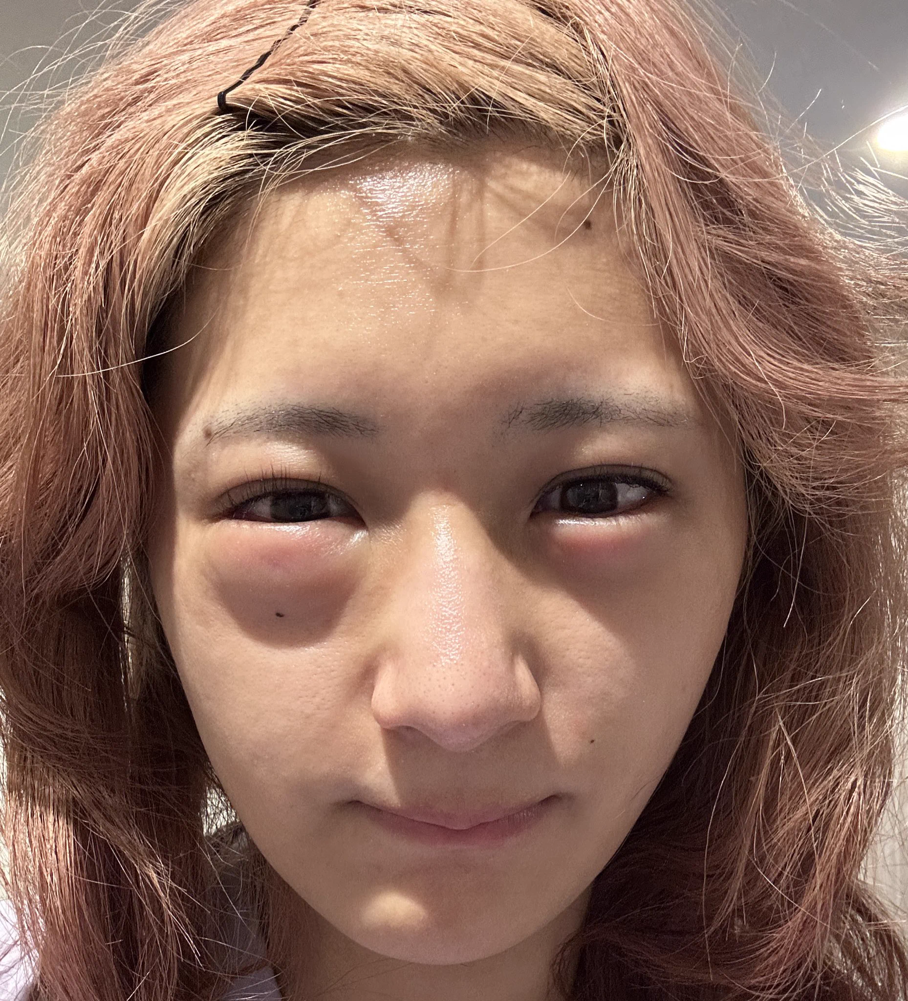 クインケ 浮腫 まぶた 写真