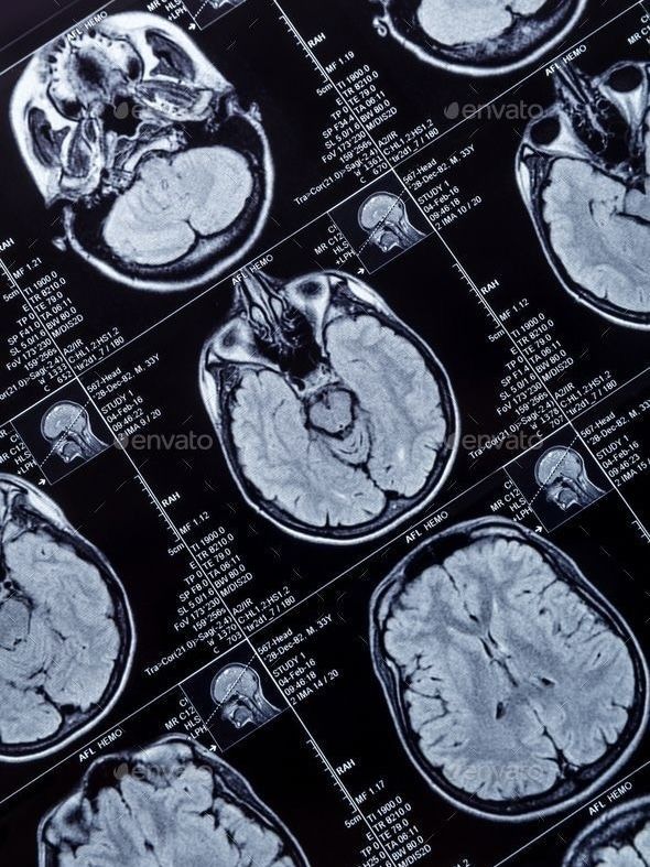 wazazbi's tweet image. ㅤ
ㅤ
This shows multiple axial MRI brain slices likely T2 or FLAIR sequences.

Unlike the first image you shared (which clearly showed a ring-enhancing lesion consistent with brain abscess), this scan does not show any obvious focal mass, abscess, or ring-enhancing lesion
ㅤ
ㅤ
