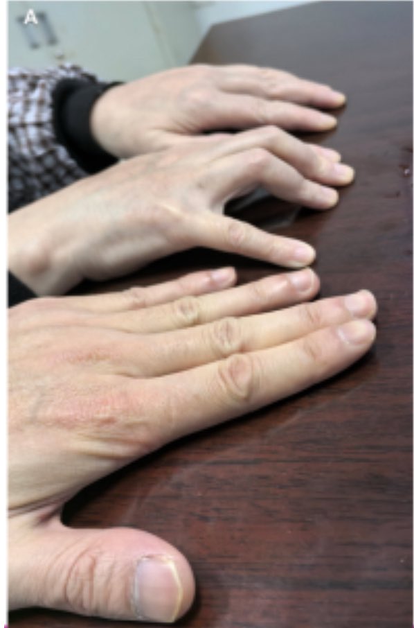Genç TRASD (@genctrasd) on Twitter photo 💥 An atypical clinical manifestation of eosinophilic fasciitis: Isolated Hand Involvement <a href="/ArmenYuri/">Armen Yuri Gasparyan</a> <a href="/dr_ismihan/">Dr.ismihan</a> <a href="/BurhanFatihKoy1/">Burhan Fatih Koçyiğit</a> <a href="/abdulvahap_md/">Abdulvahap Kahveci</a> <a href="/ArchofRheum/">Archives of Rheumatology</a>
👉 archivesofrheumatology.org/full-text/1669 💥 An atypical clinical manifestation of eosinophilic fasciitis: Isolated Hand Involvement <a href="/ArmenYuri/">Armen Yuri Gasparyan</a> <a href="/dr_ismihan/">Dr.ismihan</a> <a href="/BurhanFatihKoy1/">Burhan Fatih Koçyiğit</a> <a href="/abdulvahap_md/">Abdulvahap Kahveci</a> <a href="/ArchofRheum/">Archives of Rheumatology</a>
👉 archivesofrheumatology.org/full-text/1669