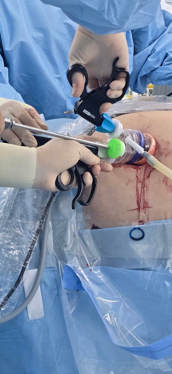drboss_urology's tweet image. Today, I performed a traditional single-port surgery after a long time.

Case went well, but I was reminded of the true greatness of the da Vinci SP by @IntuitiveSurg

#daVinciSP #SP #RoboticSurgery #Urology #UroSoMe #MedTwitter @snuh_official #SNUH
