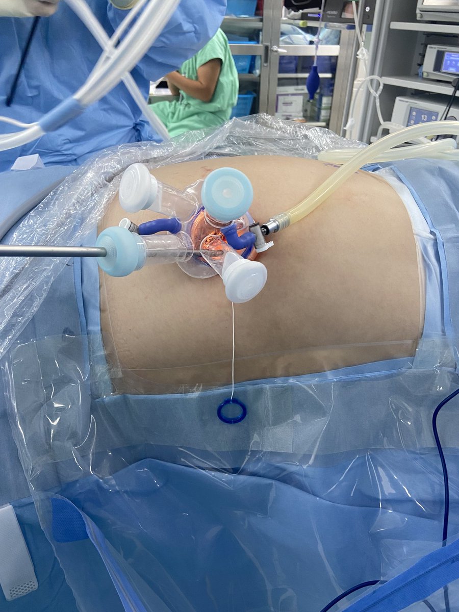 drboss_urology's tweet image. Today, I performed a traditional single-port surgery after a long time.

Case went well, but I was reminded of the true greatness of the da Vinci SP by @IntuitiveSurg

#daVinciSP #SP #RoboticSurgery #Urology #UroSoMe #MedTwitter @snuh_official #SNUH
