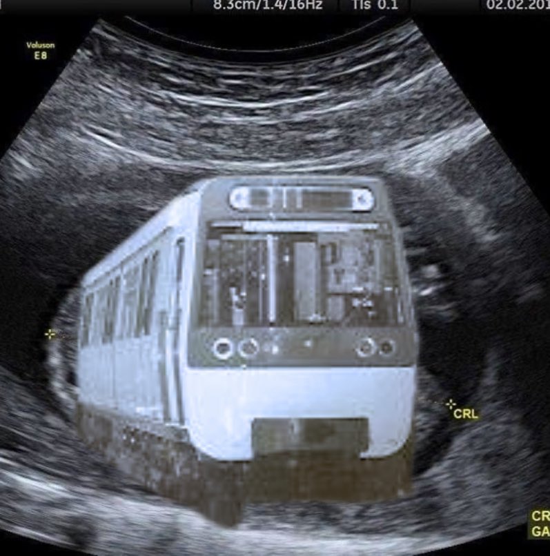 📸 ARCHIVE 📸

Voici une photo inédite de la ligne 8 dans mon ventre à 8 mois de grossesse 🤰🏼