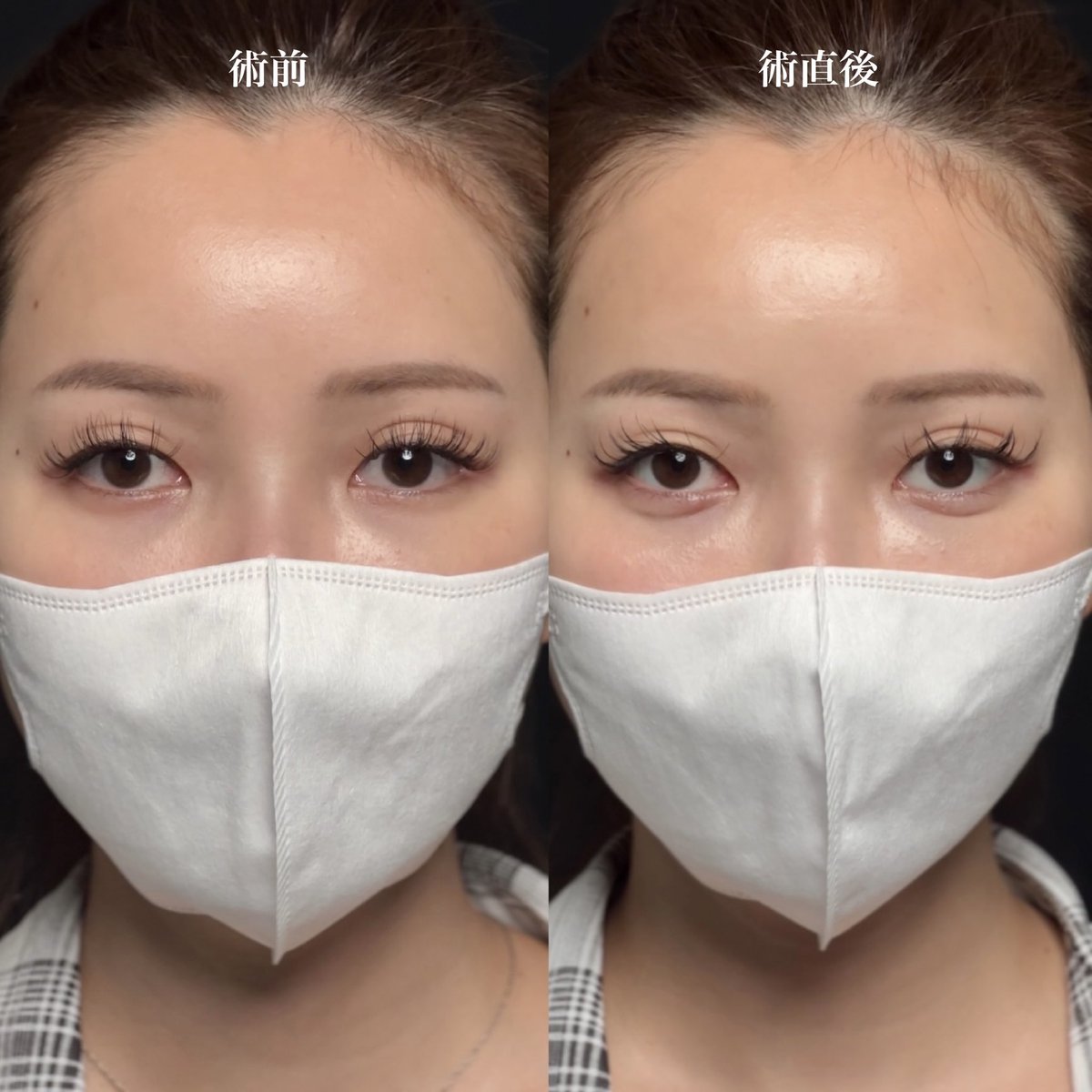 【外科的涙袋形成術】
術前→術直後

・注入一切なし
・涙袋形成しかしてない
・ノーメイクでこの変化

#切らない涙袋形成