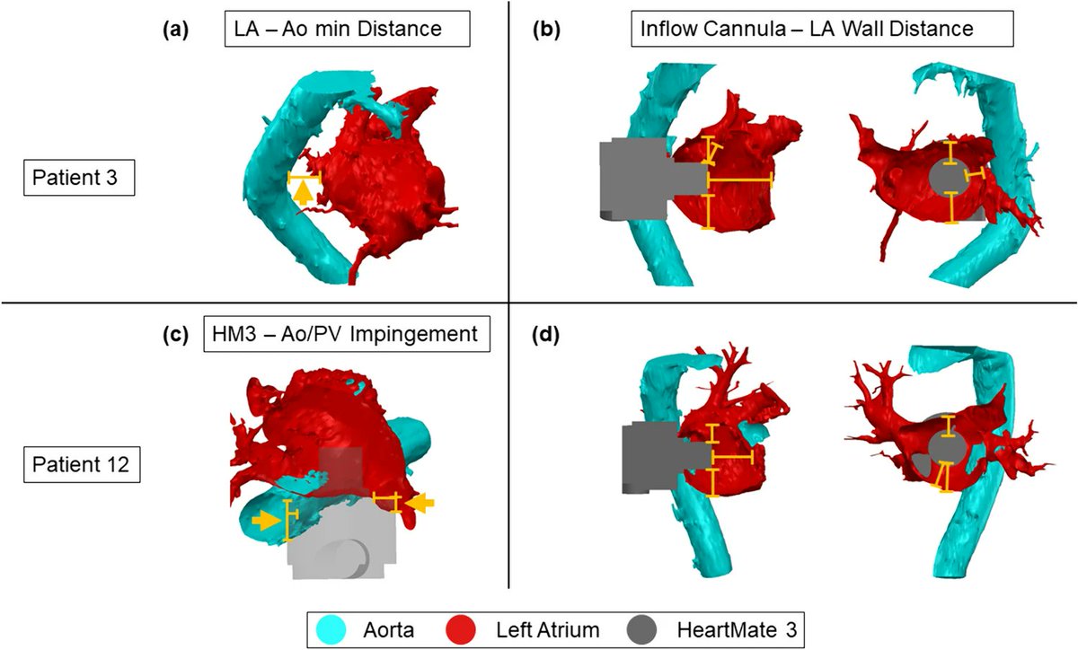 Heart failure with preserved ejection fraction (HFpEF) presents a major clinical challenge, especially because many patients cannot benefit from standard mechanical support devices due to structural differences in the heart.

Researchers investigated a new way to help HFpEF