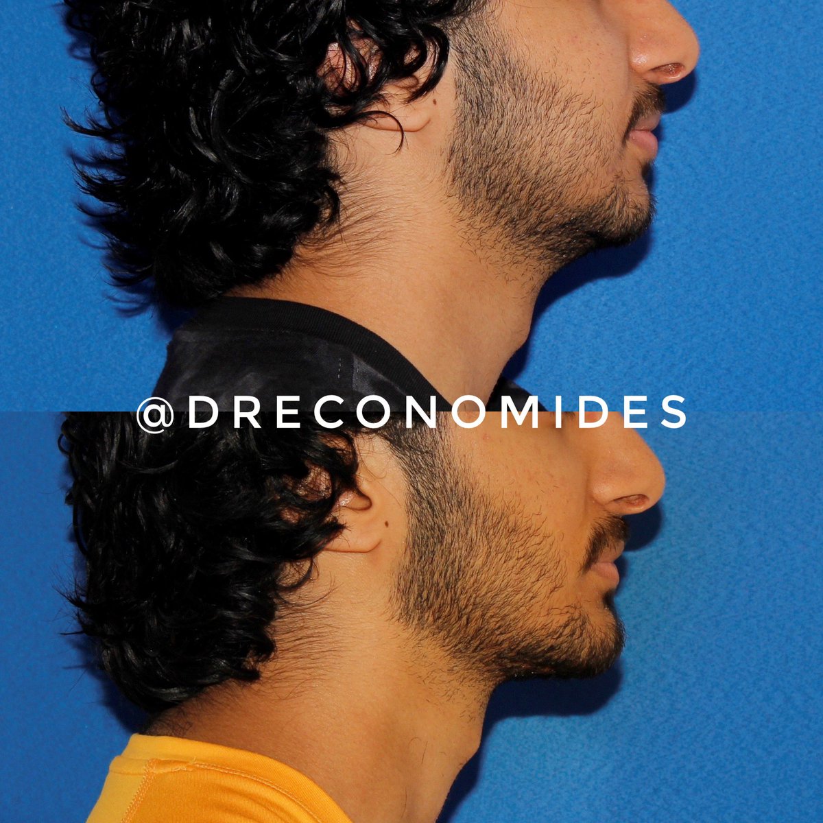 dreconomides's tweet photo. More definition and a stronger jawline for this young man. Results shown one year following comprehensive lower face rebalancing. This young man underwent deep neck sculpting to sharpen the submental area, buccal fat pad removal to rid himself of a ‘baby faced’ appearance… https://t.co/gF0mAGima9